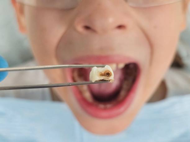 Best Emergency Tooth Extraction in Blue Rapids, KS